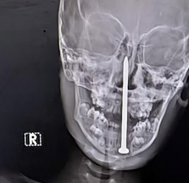 Хирурги удалили из мозга ребенка гвоздь