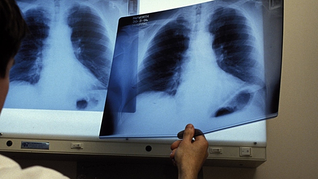 Rossija dobilas snizhenija zabolevaemosti tuberkulezom a8eca4f.jpg