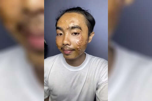 Индиец заразился контагиозным моллюском из-за одежды из секонд-хенда